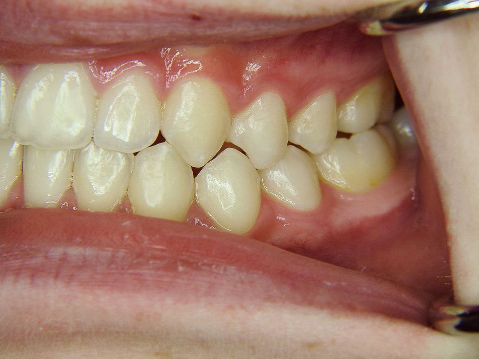 Fig. 1d: Lateral view from left after treatment