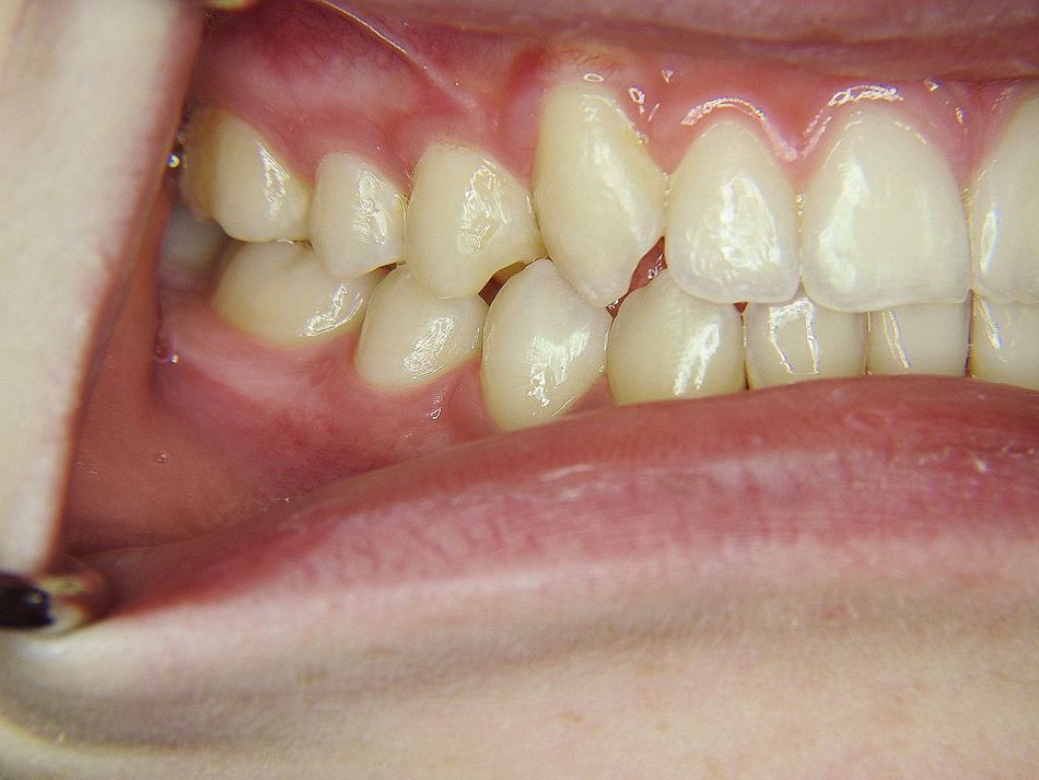 Fig. 1f: Lateral view from right after treatment