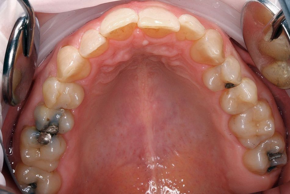 Fig. 4a: Second-degree crowding in an adult patient…