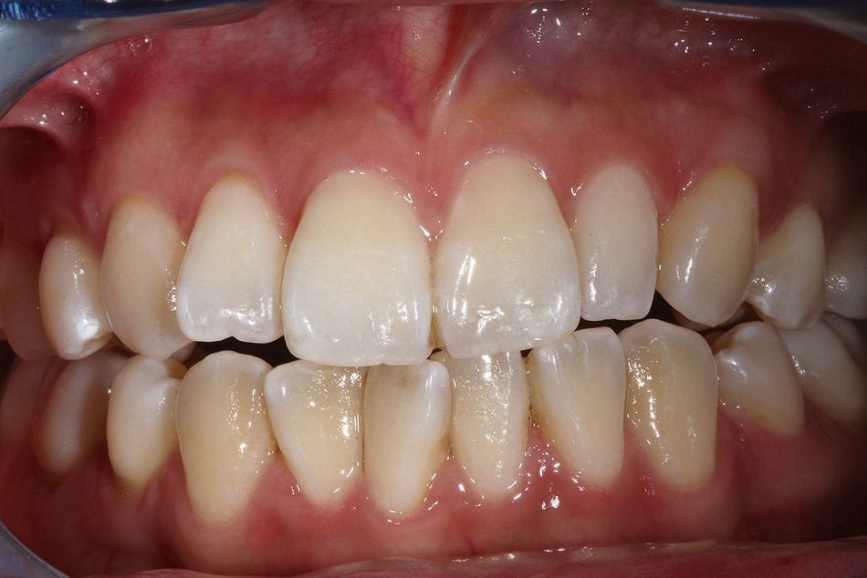Fig. 2a: Anterior view before aligner treatment