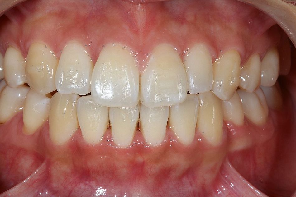 Fig. 2b: Anterior view after aligner treatment