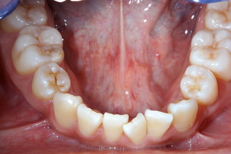 Fig. 2c: Lower jaw before aligner treatment
