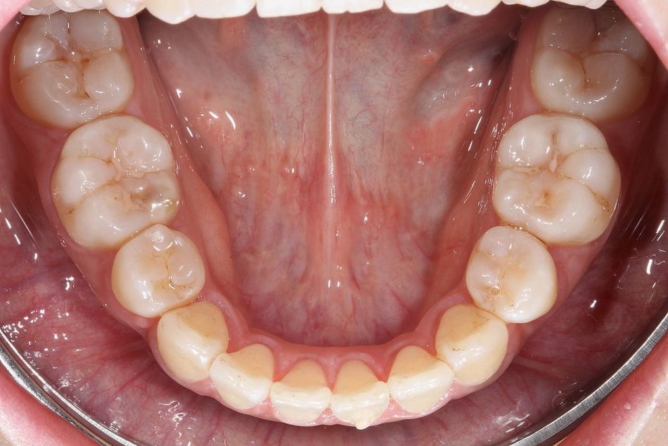 Fig. 2d: Lower jaw after aligner treatment