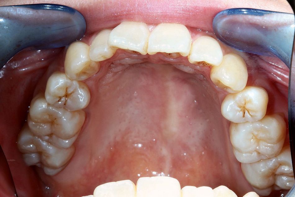 Fig. 2e: Occlusal view of the upper jaw before aligner treatment