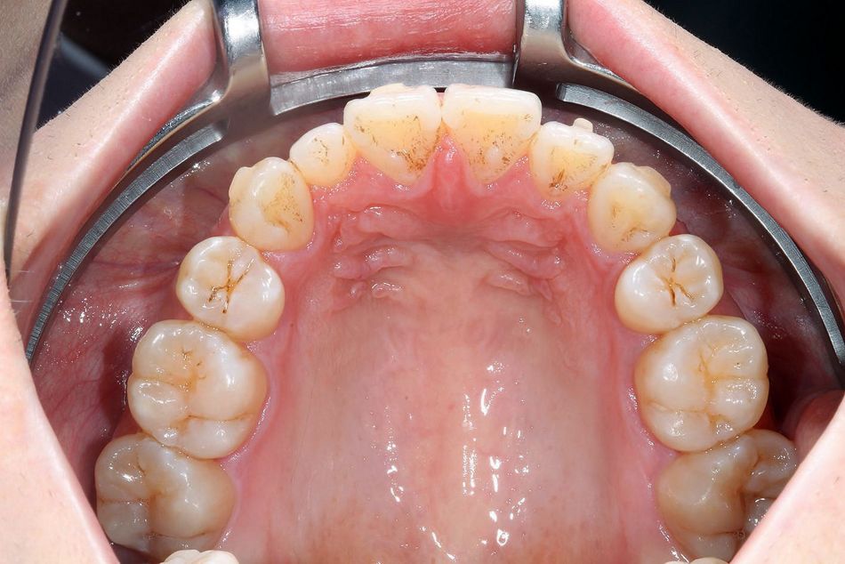 Fig. 2f: Occlusal view of the upper jaw after aligner treatment