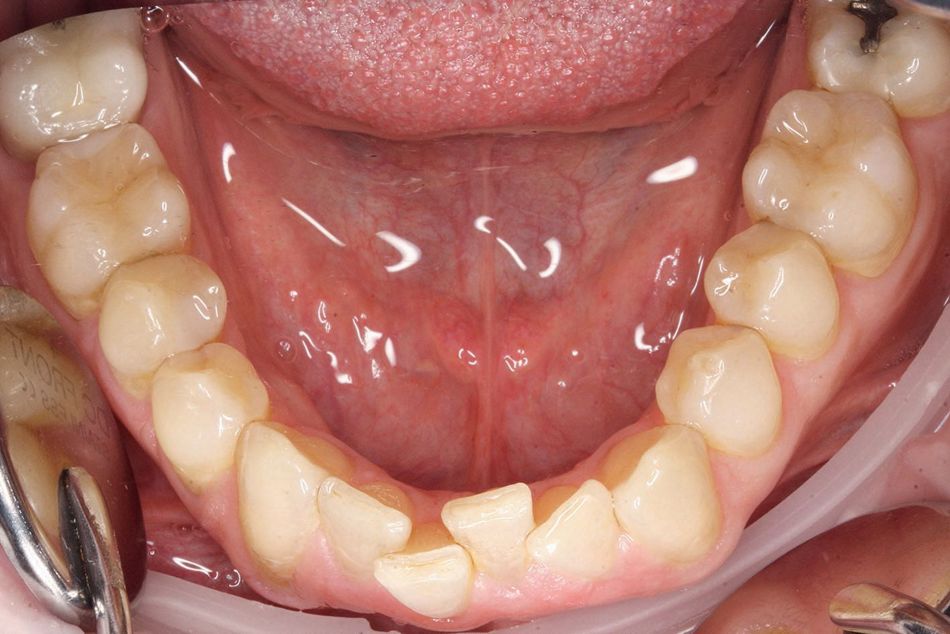 Fig. 4b: … wanting a well-formed dental arch for esthetic and periodontal prophylactic reasons
