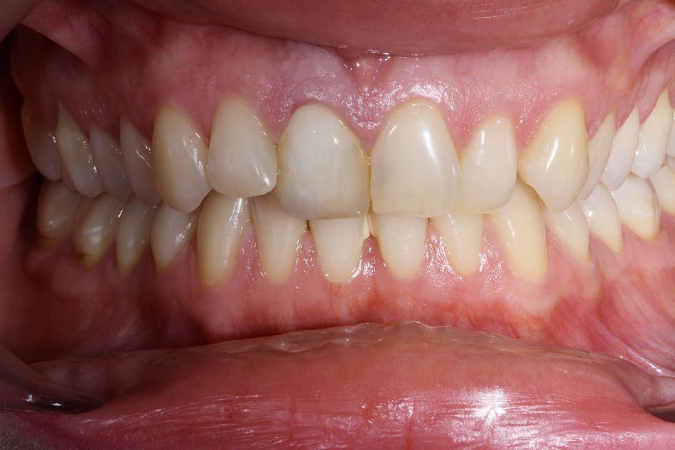 Fig. 3a: Anterior view of closed bite before aligner treatment
