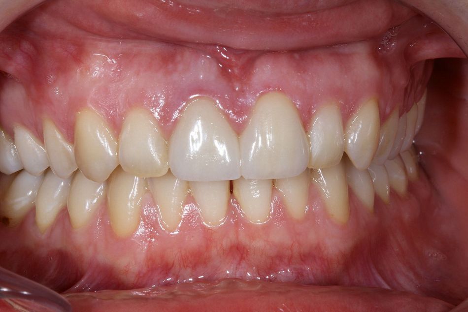 Fig. 3b: Anterior view of closed bite after aligner treatment