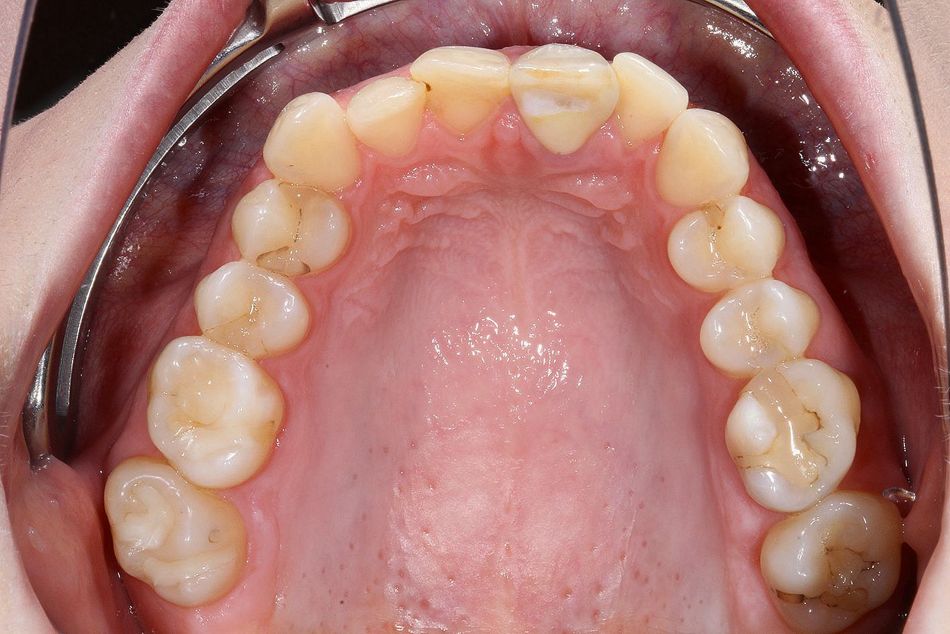 Fig. 3c: Occlusal view of the upper jaw before aligner treatment
