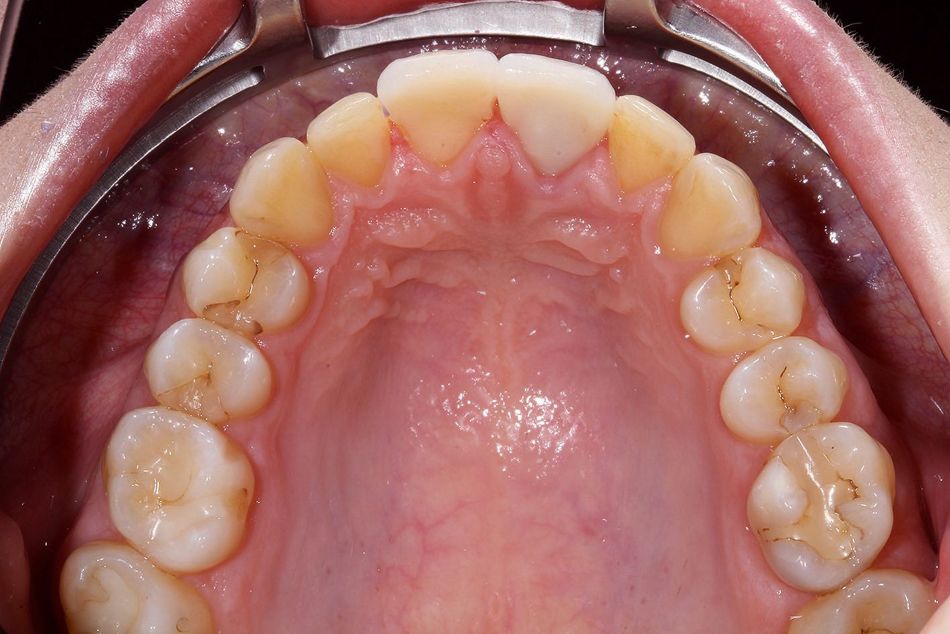 Fig. 3d: Occlusal view of the upper jaw after aligner treatment