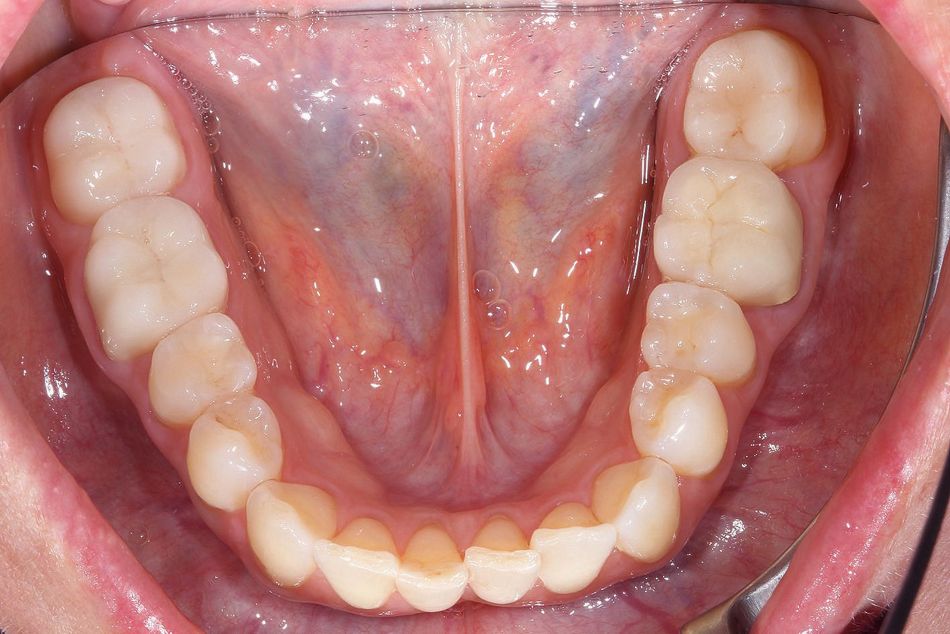 Fig. 3e: Occlusal view of the lower jaw before aligner treatment