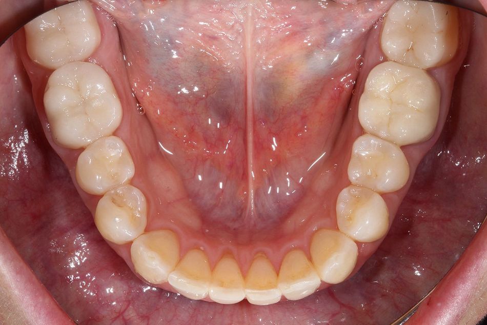 Fig. 3f: Occlusal view of the lower jaw after aligner treatment