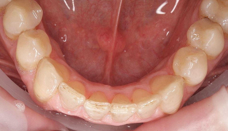 Fig. 4c: Final result of the shaped arch in the upper and lower jaw after consistently wearing a total of 20 aligners for a period of ten months