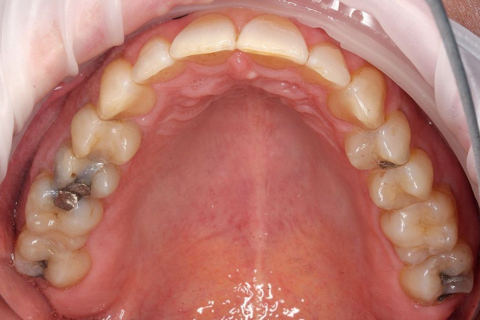 Fig. 4d: Final result of the shaped arch in the upper and lower jaw after consistently wearing a total of 20 aligners for a period of ten months
