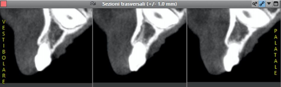 Fig. 10: CBCT showed a thick cortical bone and adequate trabecular bone in the deciduous tooth site, as well as the feasibility of placing there an implant.