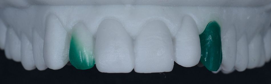 Fig. 16: Diagnostic wax-up