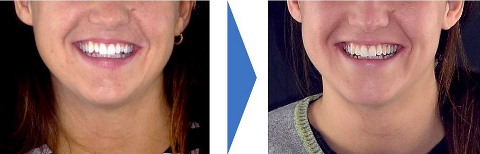 Fig. 17: It is important to analyze the integration of new tooth shapes in the patient’s face. Comparing the image related to the initial situation with the planned one, it is clear that the smile has been evidently improved. Being the patient really satisfied, the wax-up related to this dental display will be used for the computer analysis.