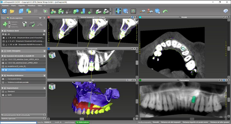 Fig.18: Planning the case step-by-step with coDiagnostiX®.