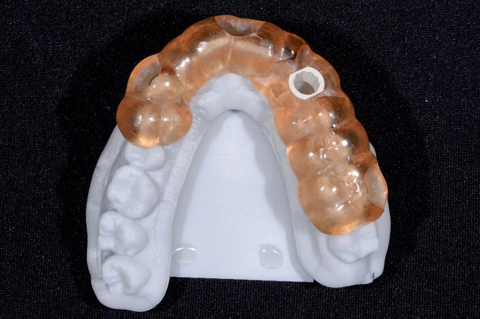 Fig. 21: The guide seated on the printed model to verify the precision of the procedure.