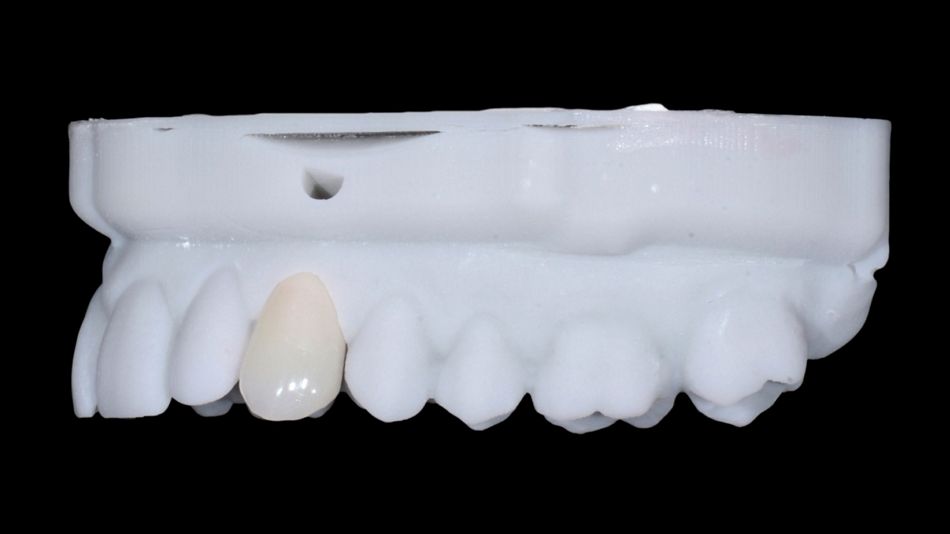 Fig. 22: Lateral view of the printed model: Note that the shape of the provisional canine crown is now in line with the adjacent teeth. 