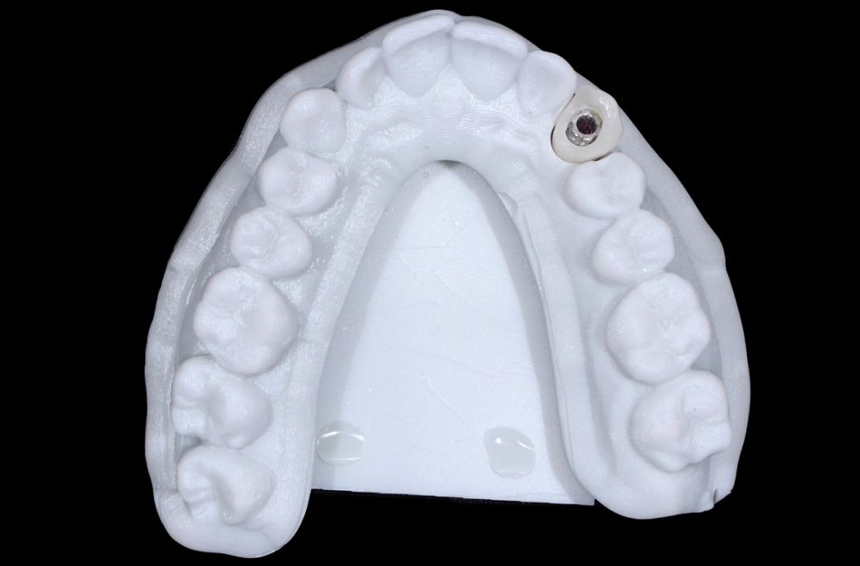 Fig. 24: The occlusal view shows the provisional abutment and the temporary crown adapted on top of it. 