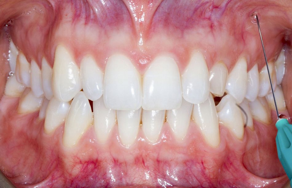 Fig. 25: Anesthetic infiltration in the area corresponding to the canine apex.