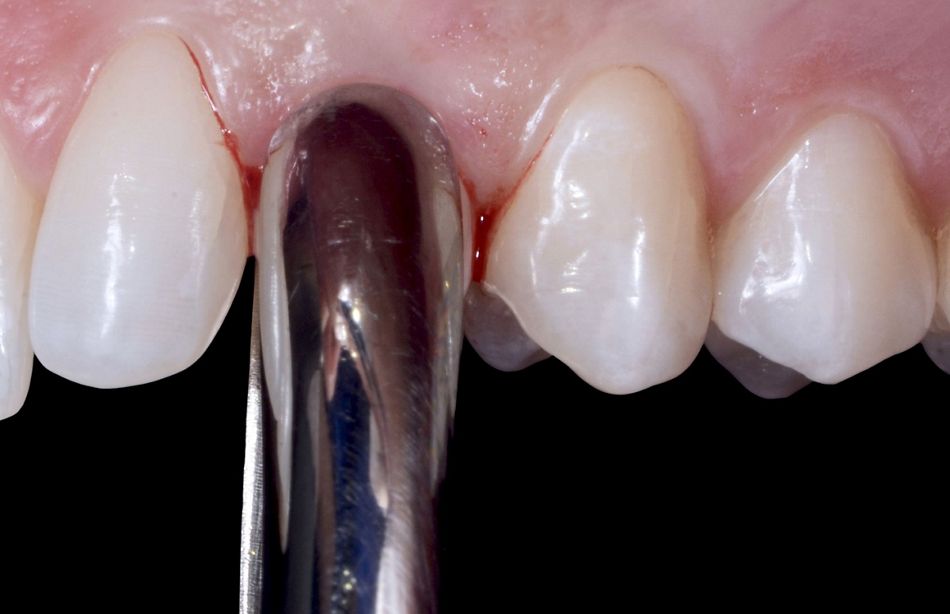 Fig. 26: Plier in position for the extraction procedure.