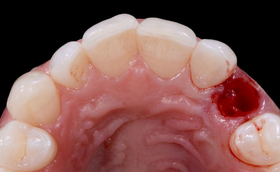 Fig. 28: Occlusal view of the extraction socket.