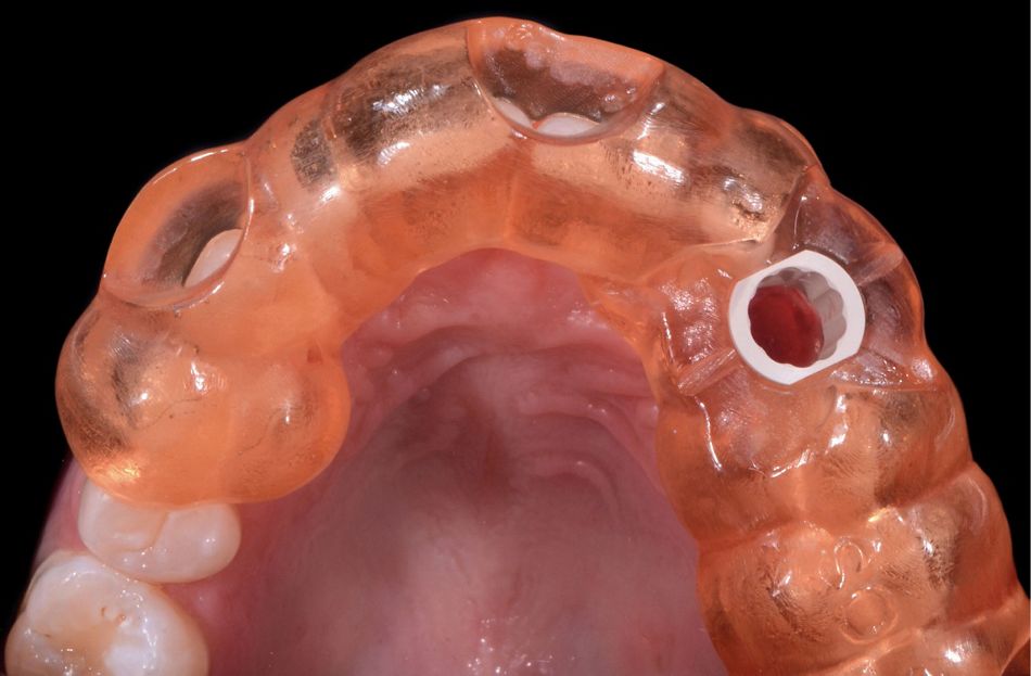 Fig. 29: After the extraction, the guide was finally checked in the patient’s mouth: It is important to verify the stability and the precision through the windows created into the guide in specific positions of the teeth