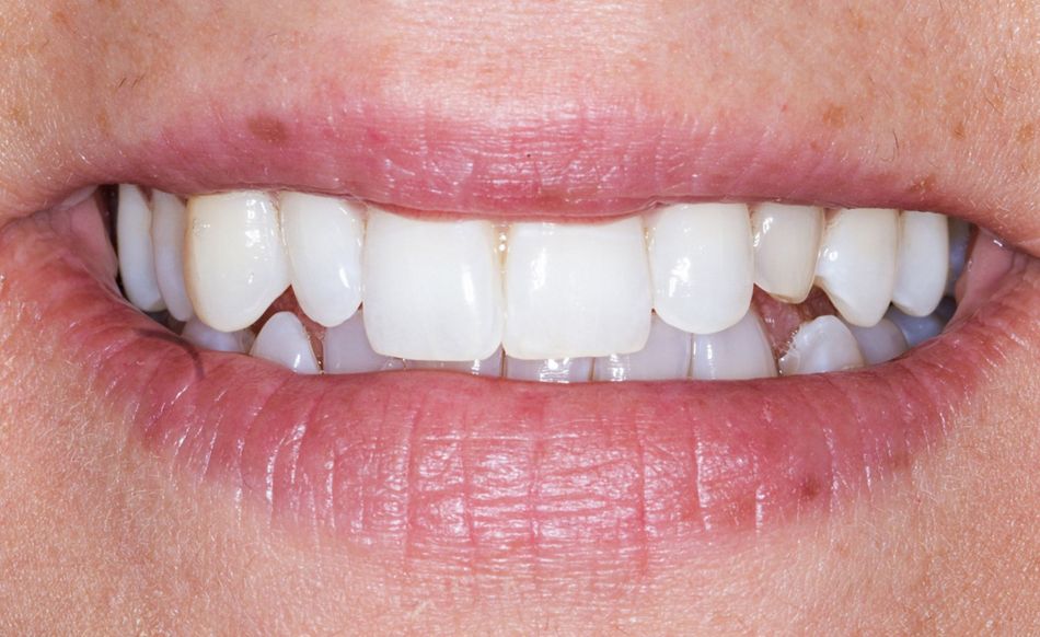 Fig. 2: Frontal view of the patient’s smile.