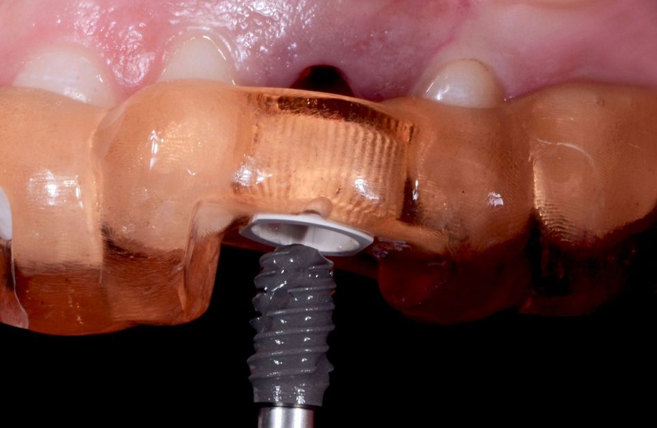 Fig. 37: The implant ready to be engaged into the sleeve for the perfect guidance in the prepared bone site.