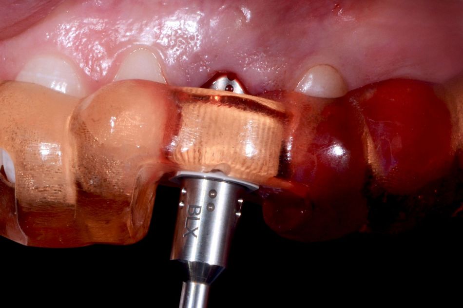 Fig. 38: The dedicated BLX transfer piece drove the implant in the correct position.