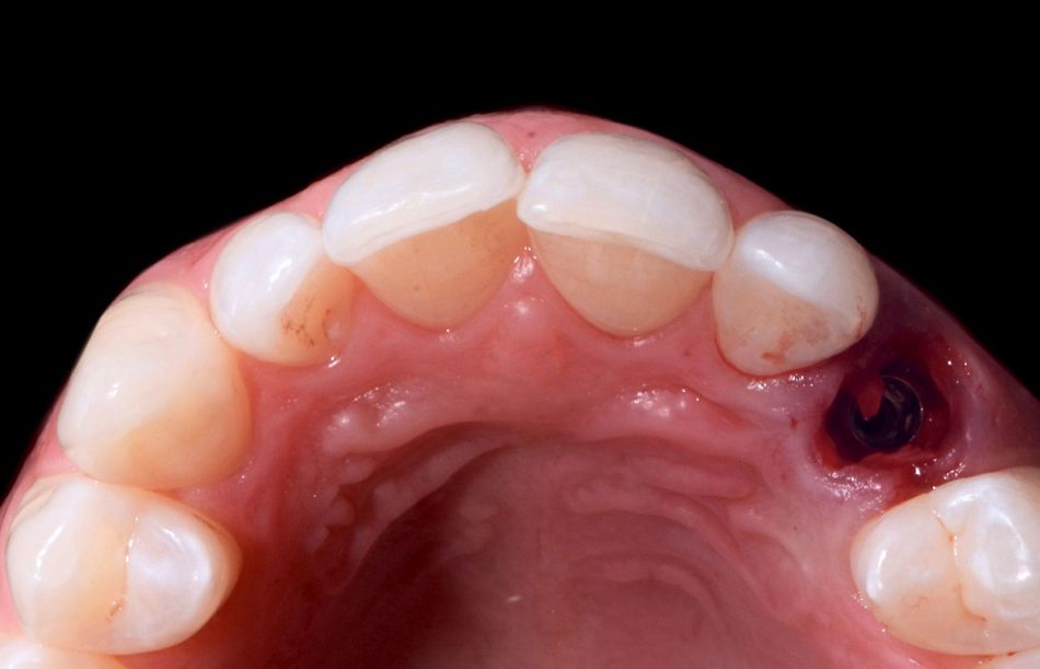 Fig. 39: Occlusal view after the implant placement and the removal of the guide.