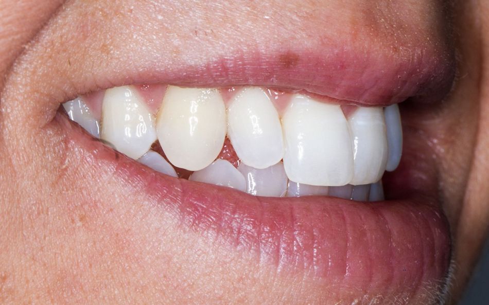 Fig. 3: Right lateral view of the patient’s smile.