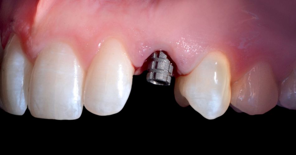 Fig. 41: The provisional abutment, shortened and sandblasted by dental lab, was screwed on top of the implant.