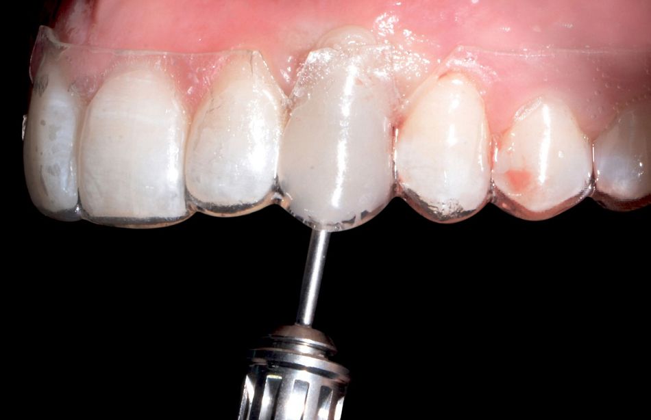 Fig. 42: After resin polimerization, the temporary crown was unscrewed.