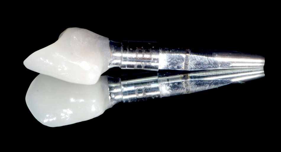 Fig. 43: Image of the crown once screwed on the analog, vestibular side.