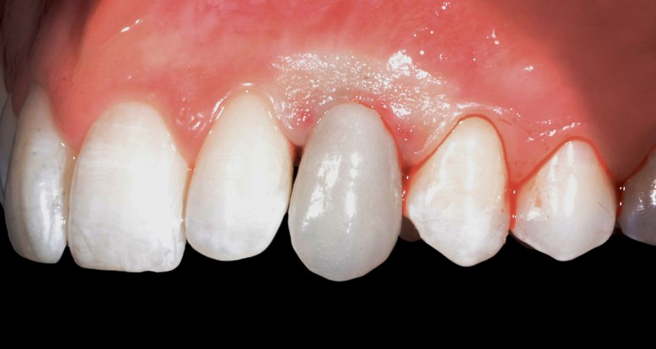 Fig. 44: After the refinements, occlusion was checked in the patient’s mouth.