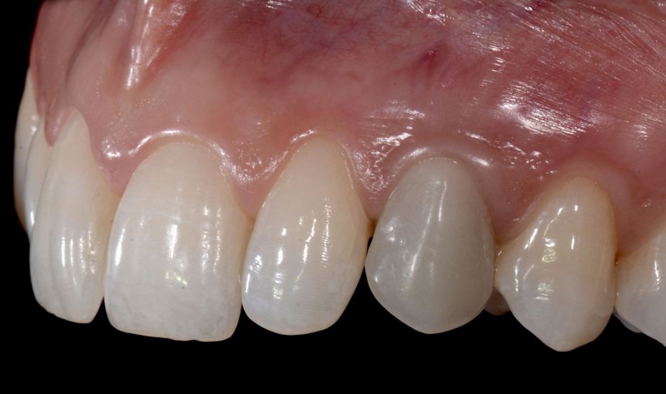 Fig. 46: Note the nice emerging profile of the temporary crown; ready for the final prosthetic phases.