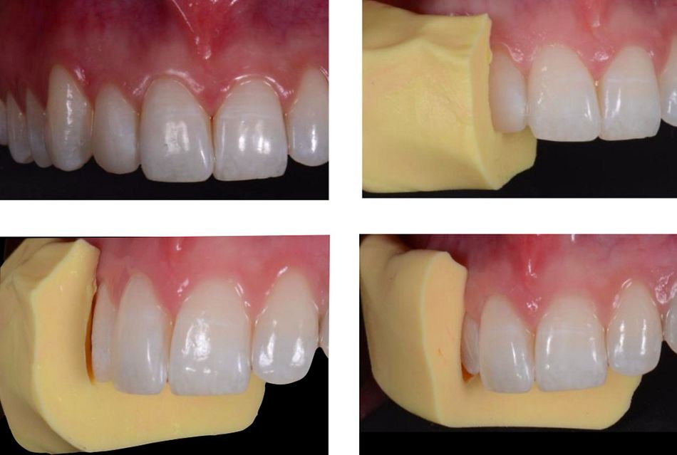 Fig. 47: The lateral incisor was treated with veneer to improve esthetics and avoid ortho treatment. This was an alternative solution offered to patient. As a first step, the mock-up was made once again and a silicon mask, created on top of it and cut in the middle, was used as a guide during the preparation of the tooth. This allowed us to pre-visualize the final shape of the tooth and to then remove the correct amount of enamel and create the exact space for the ceramic veneer.