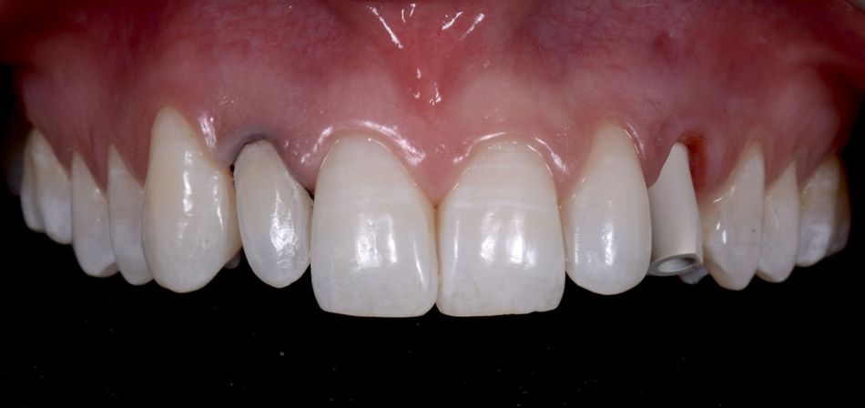 Fig. 48: Final digital impression: A dedicated scan body was screwed on top of BLX implant and a retraction cord was placed around the tooth 12 in order to highlight the finishing line preparation.