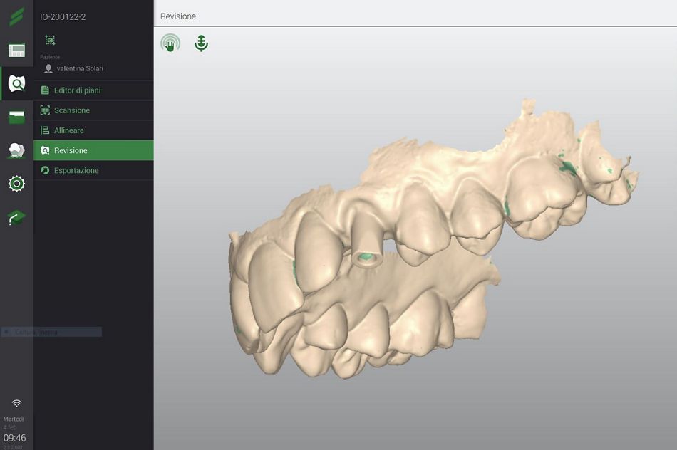 Fig. 49: Final digital impression: a screenshot of the data acquisition with the intraoral scanner DWOS.