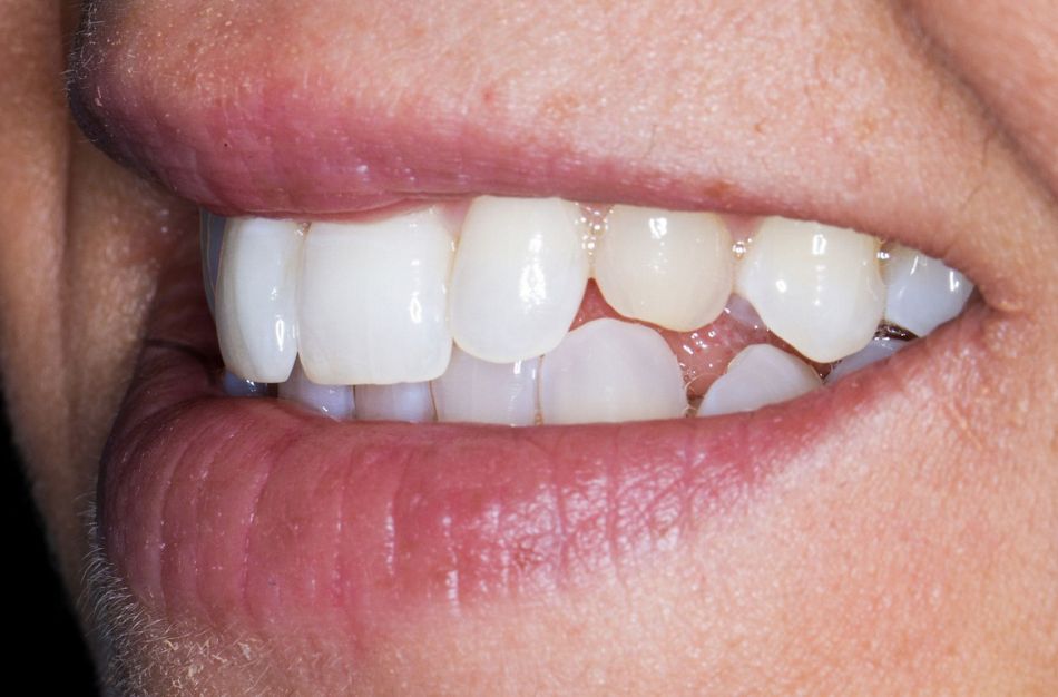 Fig. 4: Left lateral view of the patient’s smile.