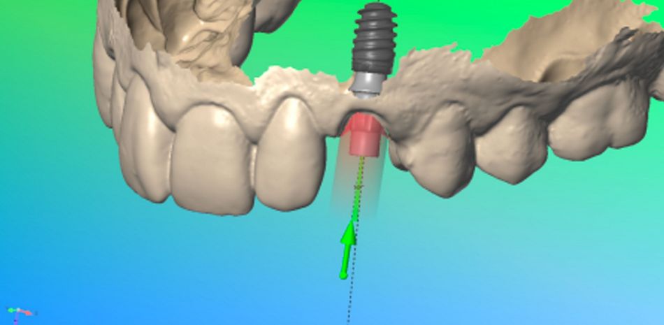 Fig. 50a and b: the STL files related to optical impression were imported in Dental Wings lab modeling software. The implant was virtually inserted into the model and the Variobase® was seated on top of it.