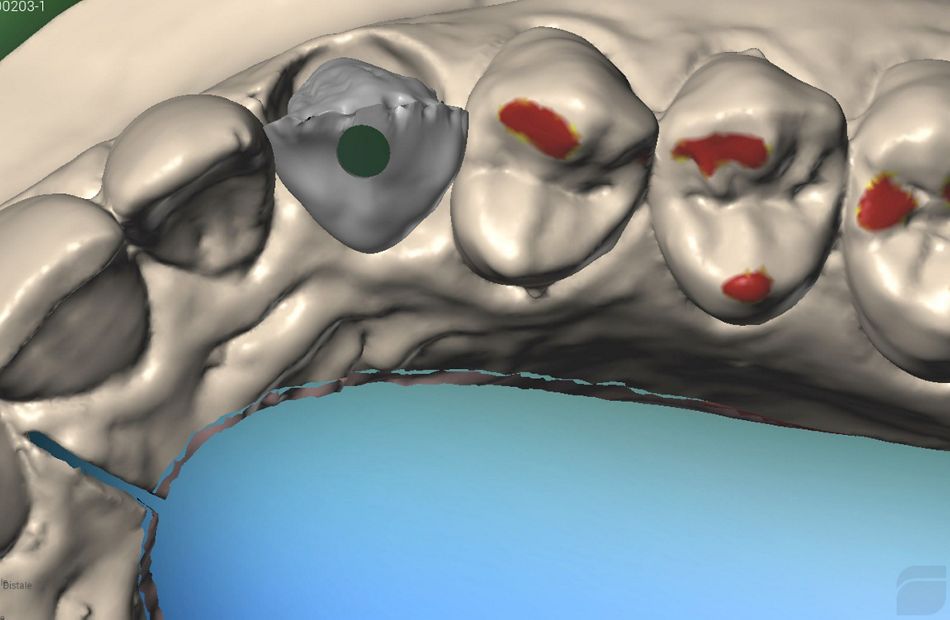 Fig. 51: Modeling of the zirconia crown to be veneered after milling on the vestibular side with ceramic. Once this procedure is completed, the zirconia crown will be produced on the basis of this project.