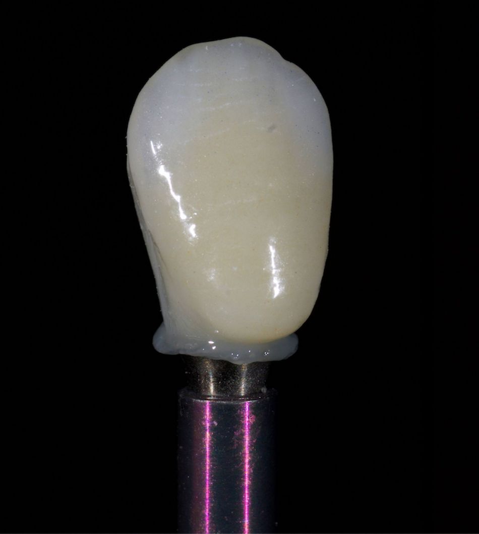 Fig. 52: After the milling of the zirconia crown and its ceramic veneering, the crown was fixed on the Variobase® by using composite cement.
