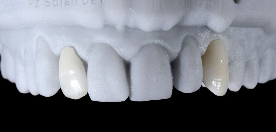 Fig. 55: Printed resin model with ceramic veneer and crown in position.