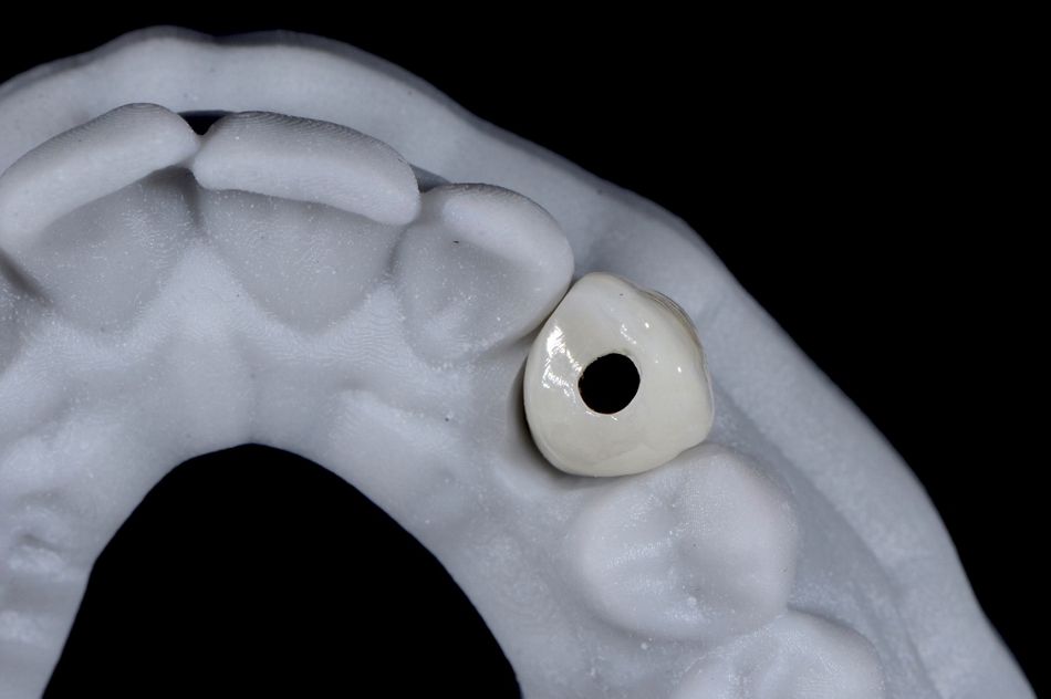 Fig. 56: Occlusal view of the crown on the model: note the exact positioning of the screw hole due to the precise implant placement with computer-guided surgery.