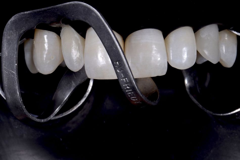 Fig. 57: Isolation of the operating field with dental dam for the cementation of the ceramic veneer: for the long-term success of the procedure it is fundamental to have an absolutely dry area.