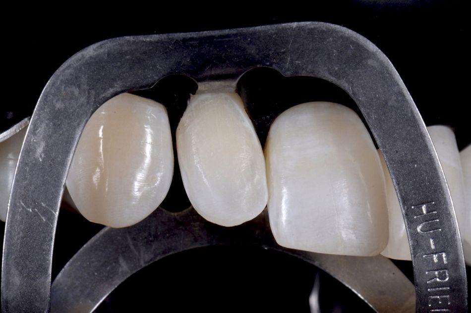 Fig. 58: A detail illustrating the finishing line of the preparation: It was perfectly visible and ideal for a correct cementation procedure.